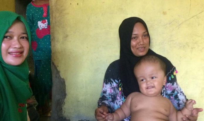 Balita Mengidap Hydrocephalus